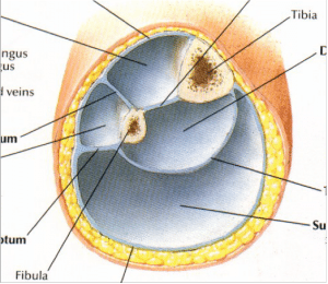 fasciotomy