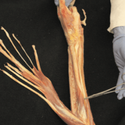 Fascial Dissection