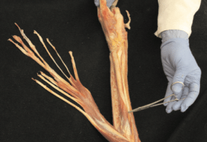 Fascial Dissection