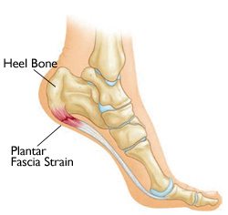 plantar fascia strain image - plantar fasciitis