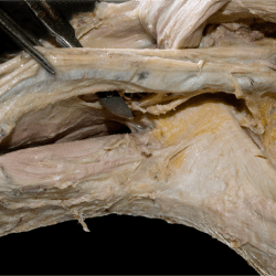 Brachial Plexus Dissection