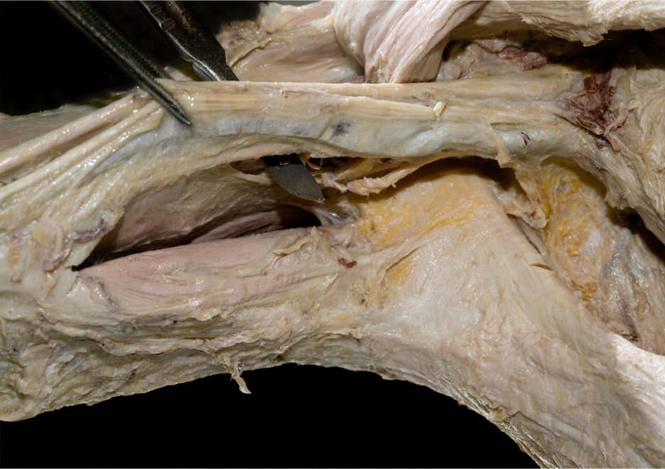 Brachial Plexus Dissection