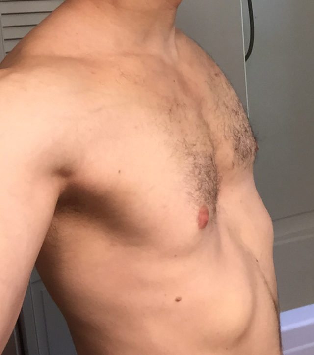 Bodywork For Funnel Chest (Pectus Excuvatum) Q &amp; A with