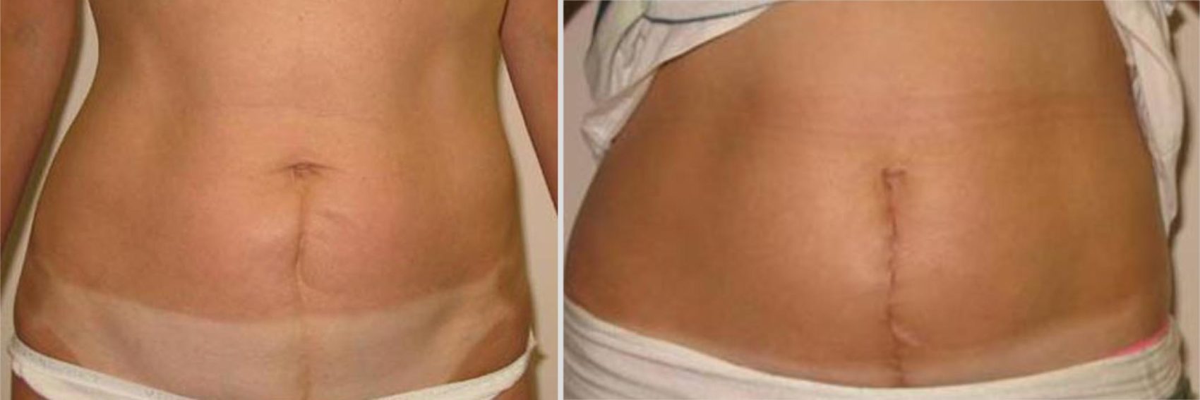 CSection Scar Tissue Release Therapy Cesarean Scar Massage