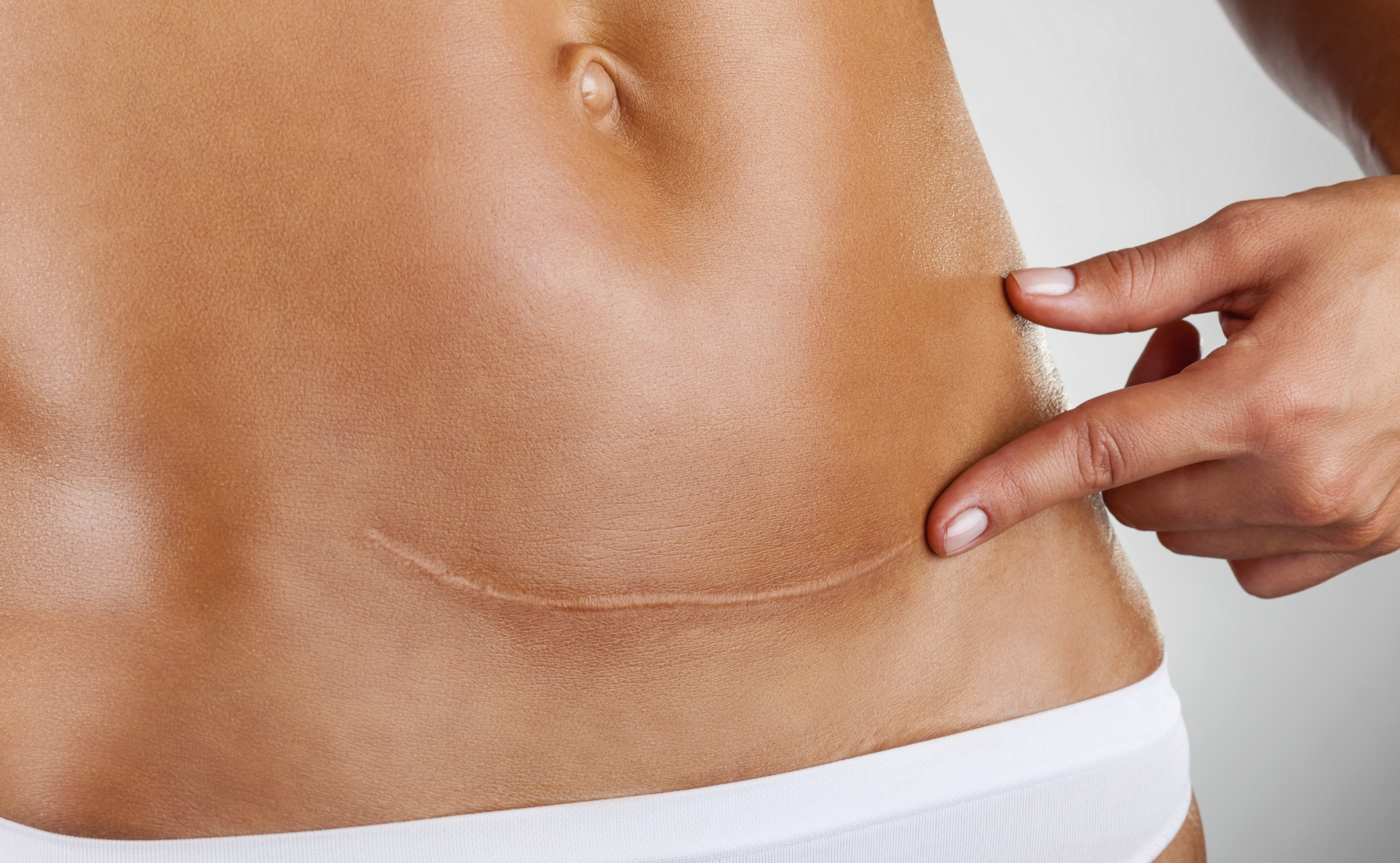 How Do I Take Care of a C-Section Scar?